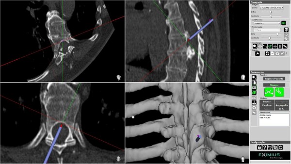 cirurgia minimamente invasiva neurológica pediatria 1