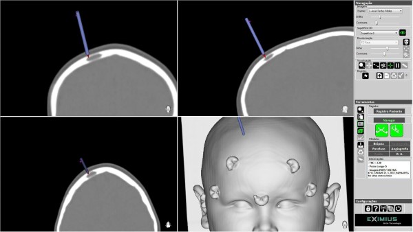 cirurgia minimamente invasiva neurológica pediatria 1