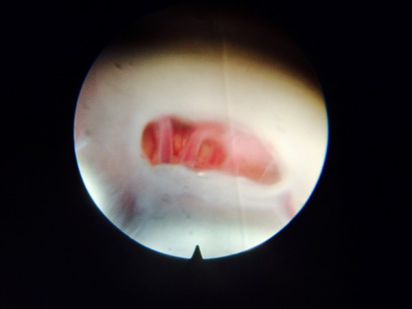 cirurgia minimamente invasiva neurológica pediatria 1